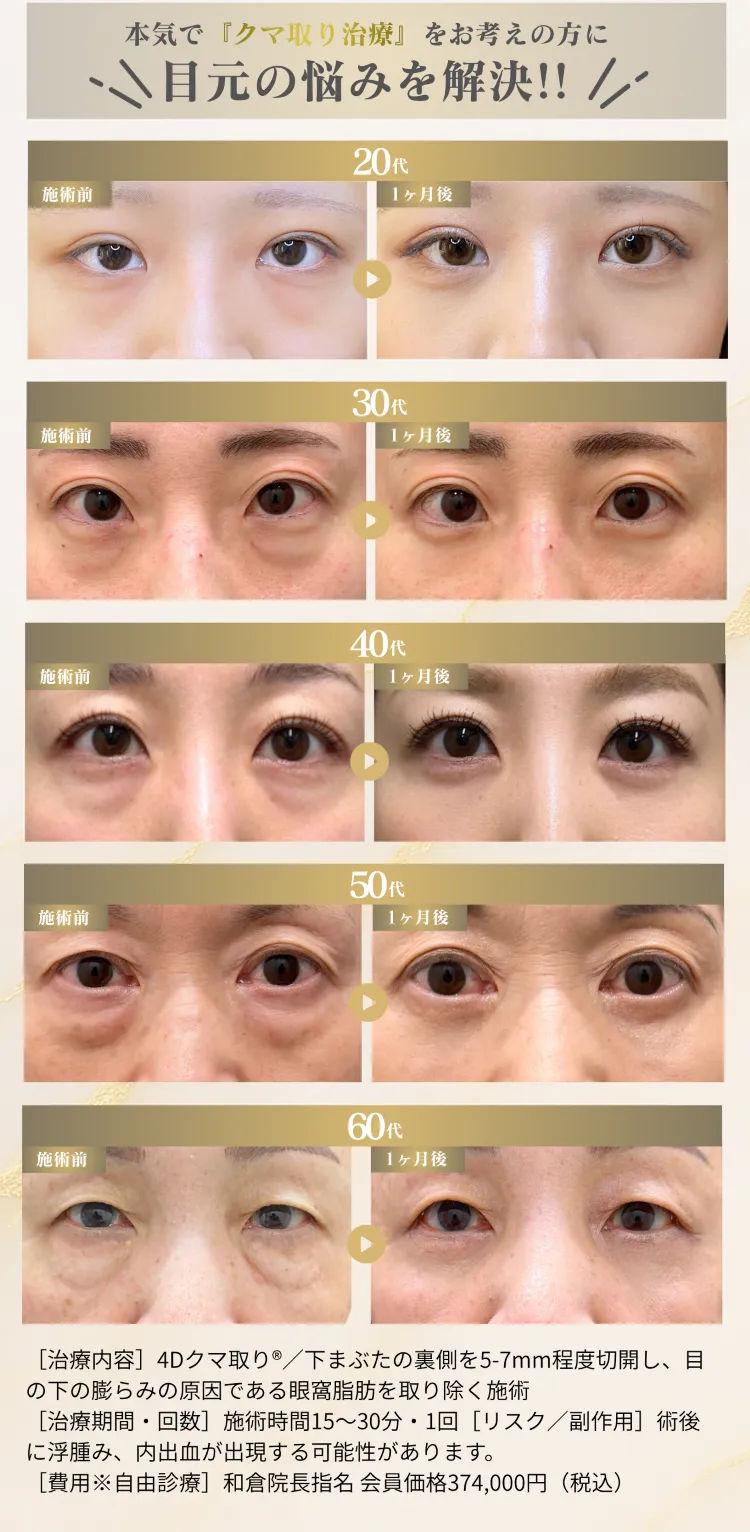 世代別 4Dクマ取り®症例（20代・30代・40代・50代・60代）— 施術前と1ヶ月後の比較写真