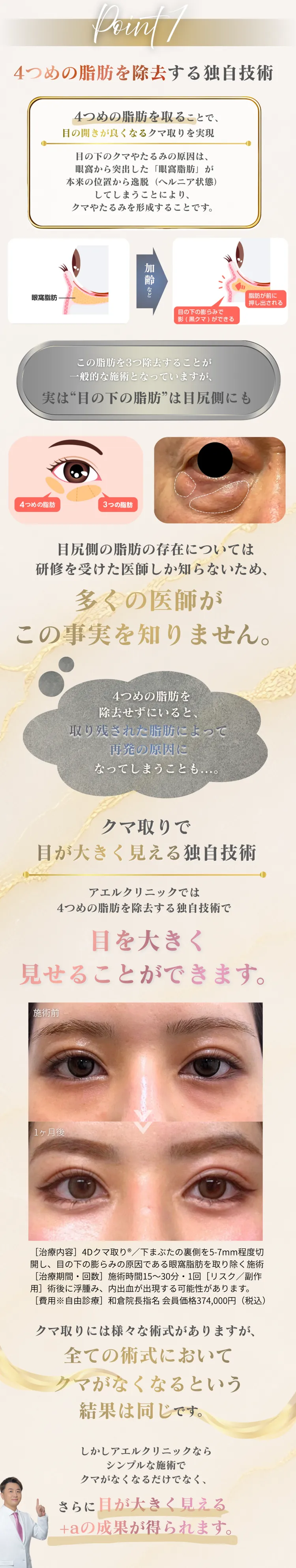 Point 1 — 4つめの脂肪を除去する独自技術。目尻側の脂肪まで除去することで目の開きが良くなるクマ取りを実現、再発リスクを軽減