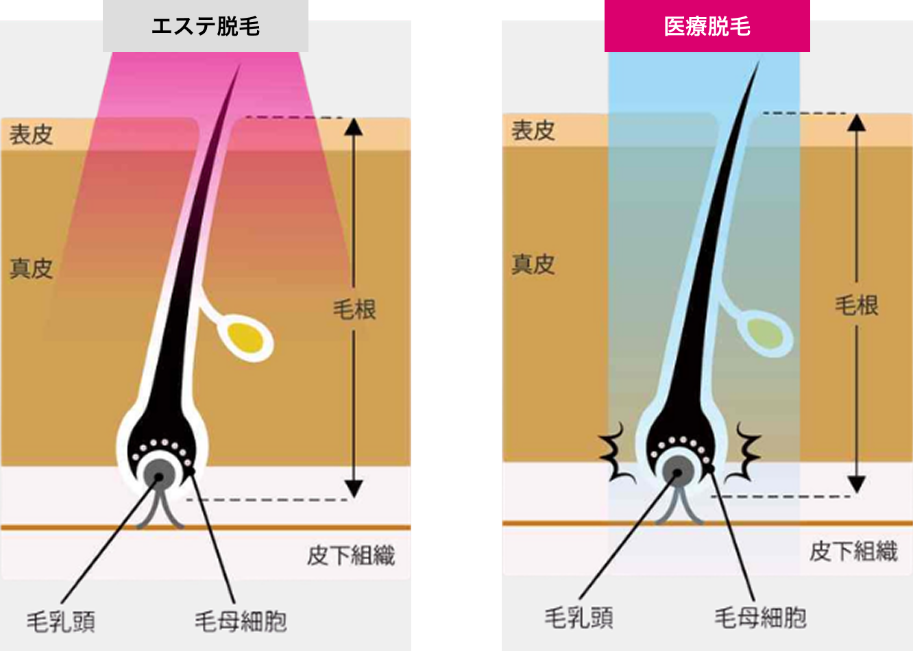 エステ脱毛と医療脱毛の皮膚断面図の比較。エステ脱毛は表皮付近までの光、医療脱毛は毛根まで届くレーザーを照射する