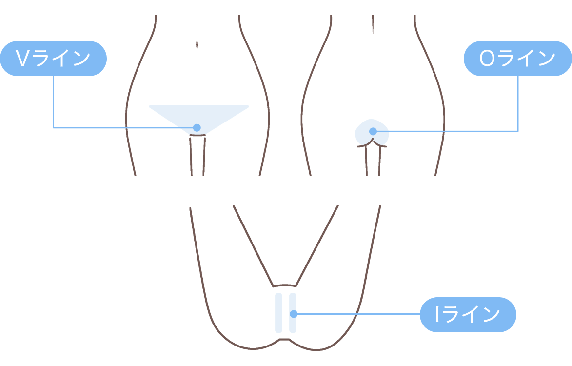 VIOの脱毛範囲（Vライン・Iライン・Oライン）を示したイラスト