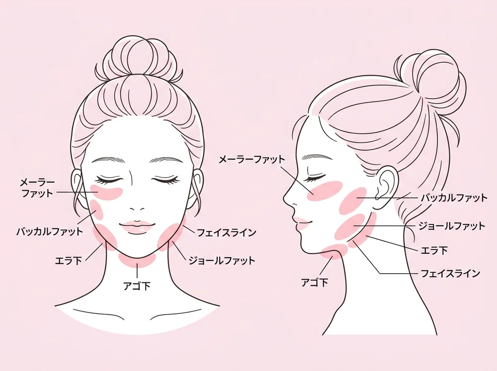 脂肪吸引（顔）の施術可能部位イラスト