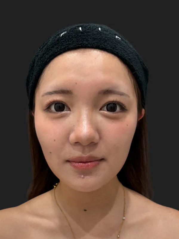 脂肪吸引（顔）施術後のフェイスライン（正面）