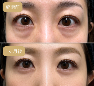 4Dクマ取り®術 施術前後の目元の変化 Before / After 比較