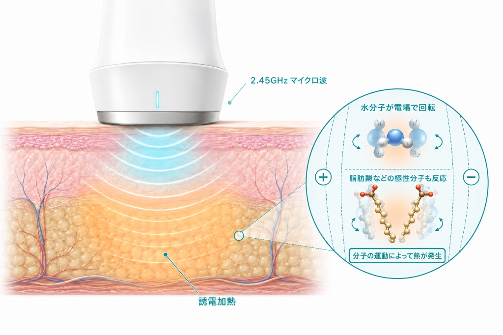 オンダリフトの作動原理イラスト。2.45GHzのマイクロ波が皮下脂肪層に届き、水分子や脂肪酸などの極性分子の運動によって誘電加熱が起こる図