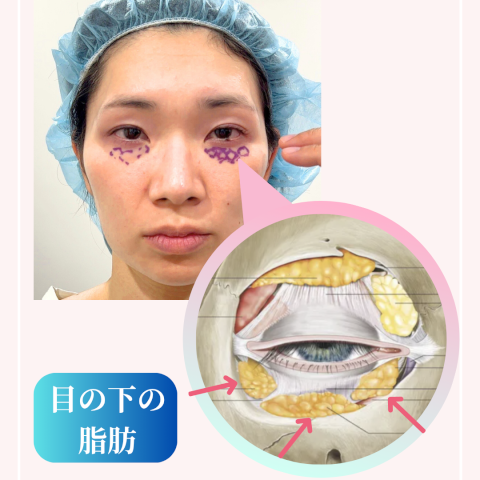 目の下の脂肪の位置