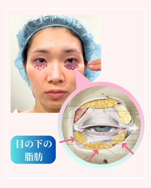 目の下の脂肪の位置