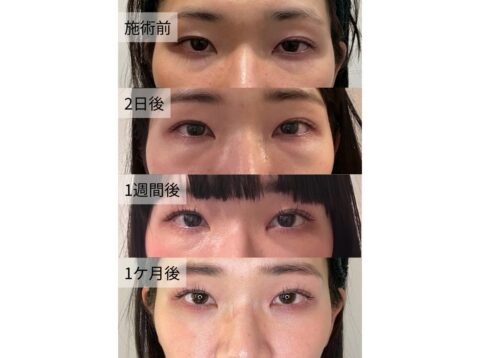 クマ 取り 整形 ダウン タイムの経過