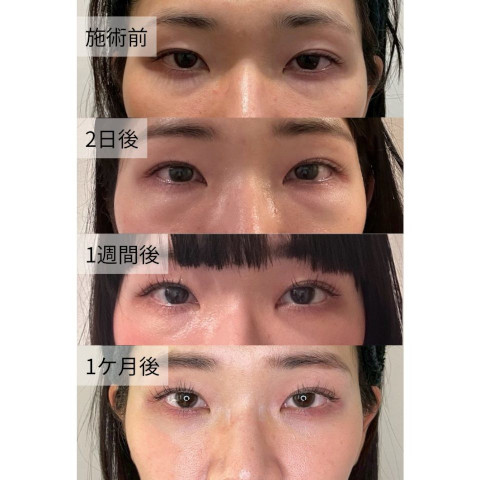 クマ 取り 整形 ダウン タイムの経過