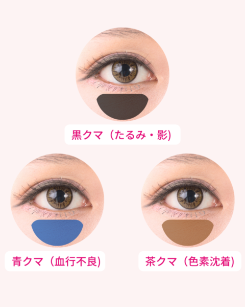 クマの種類と原因一覧