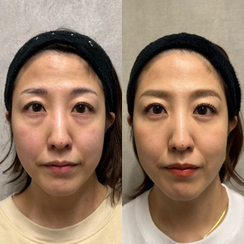 クマ取り施術の症例写真