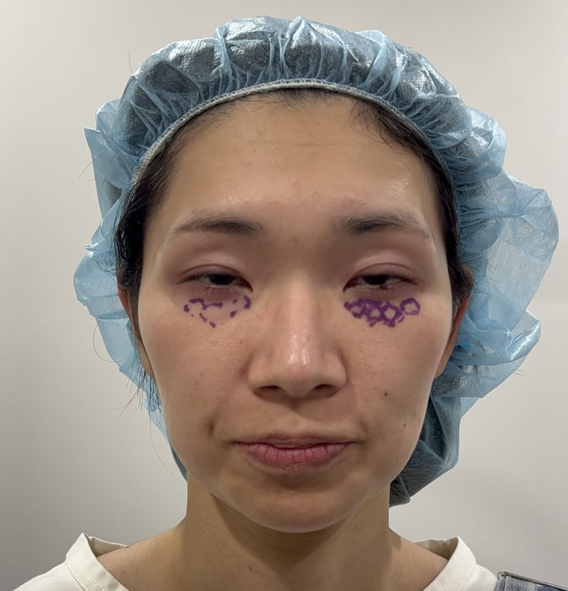 4Dクマ取り®術で除去する4つの脂肪