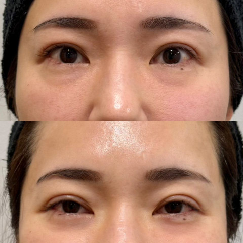 4Dクマ取り®術を受けた女性の症例写真