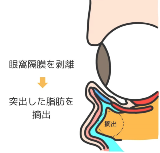 眼窩脂肪が眼窩隔膜を突き破るイメージ