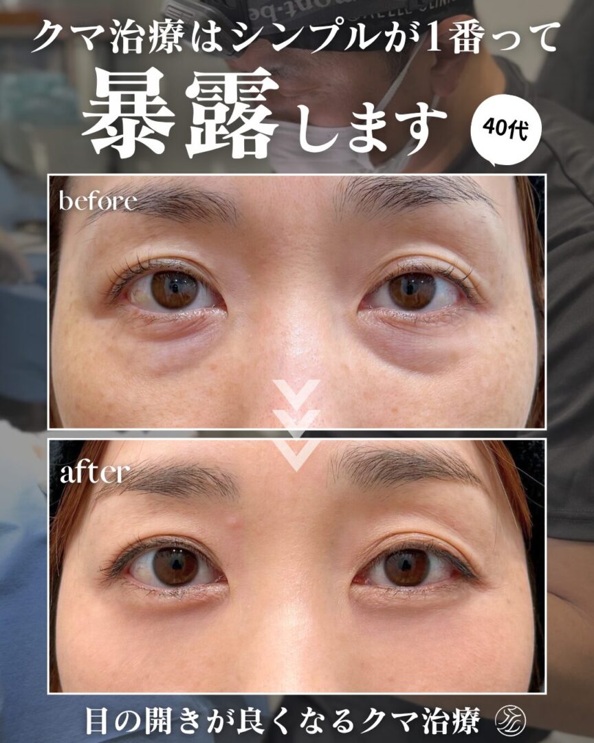 4Dクマ取り®術によって目が開きやすくなる様子