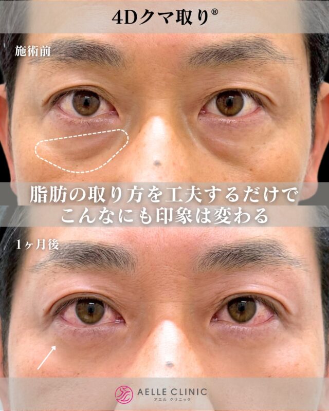 クマ取り