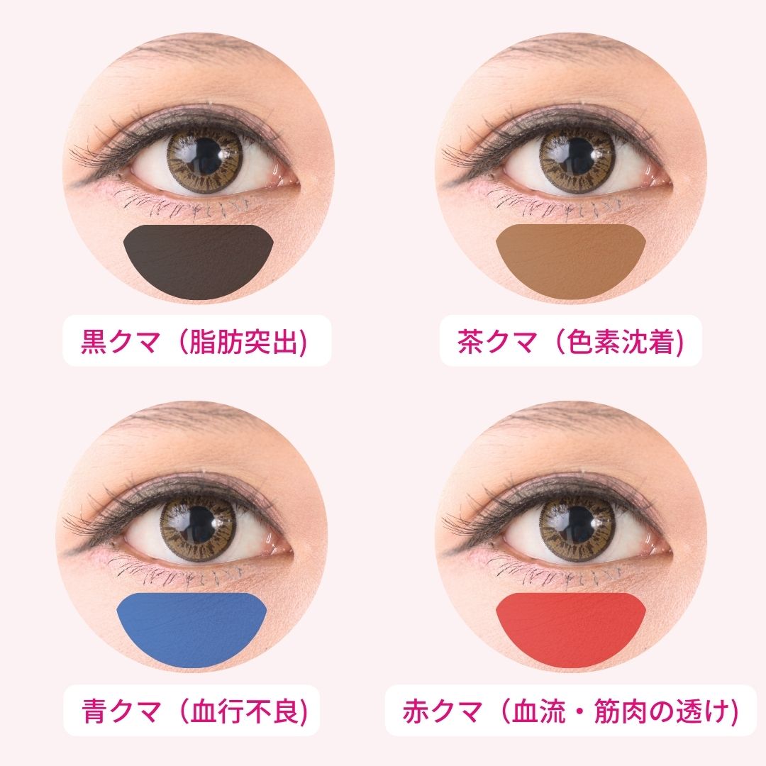 目の下のクマの4種類と原因を示した画像