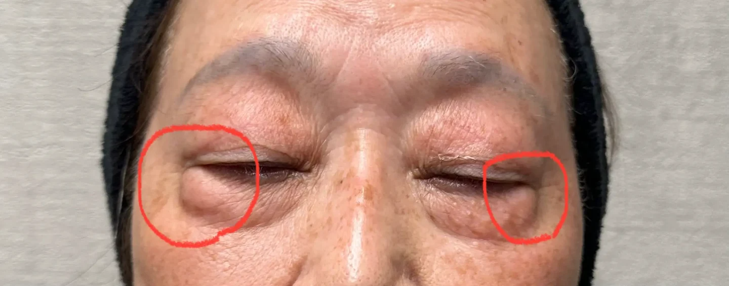 80代女性の目元。外側のふくらみの説明例