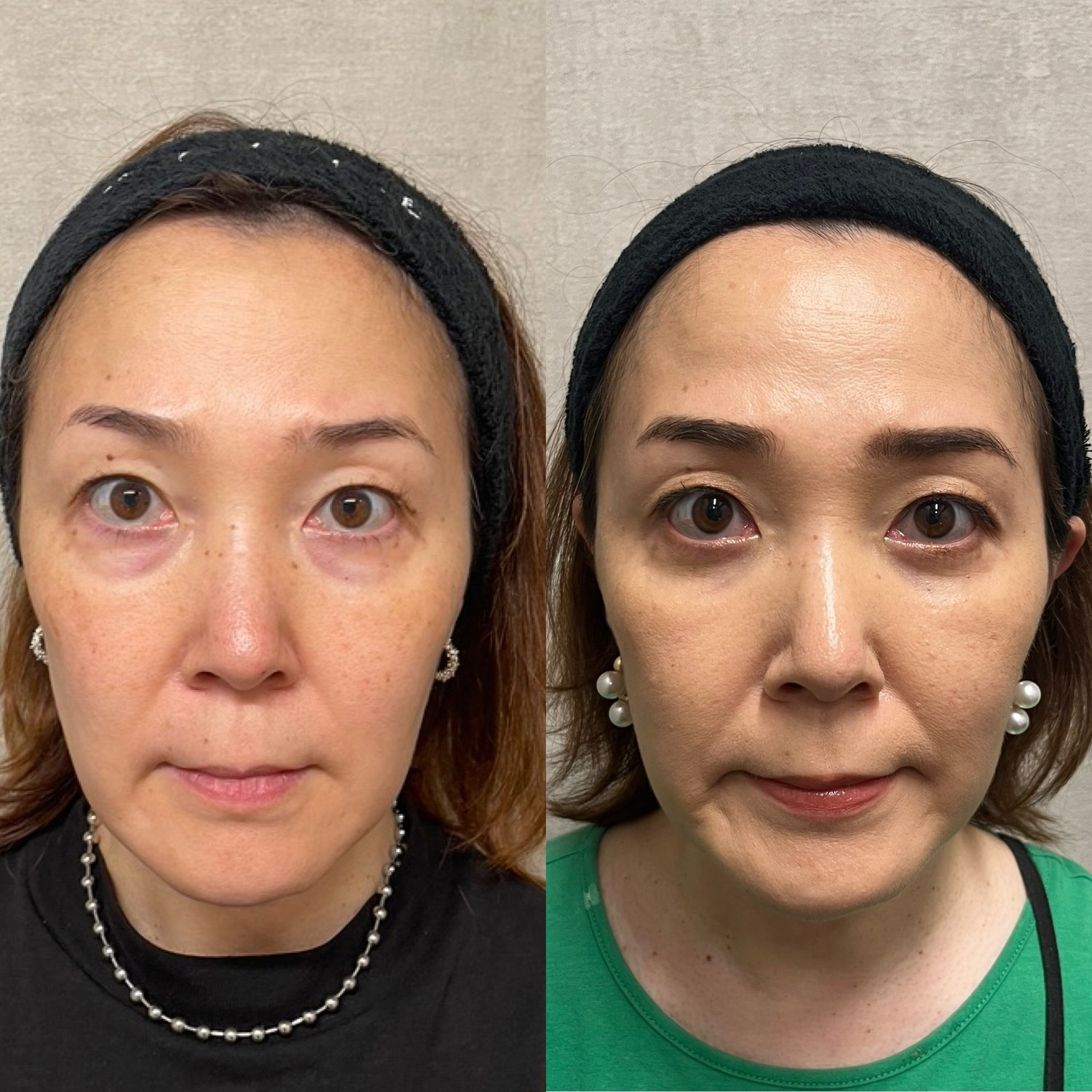 別患者様の正面。術前と術後1ヶ月