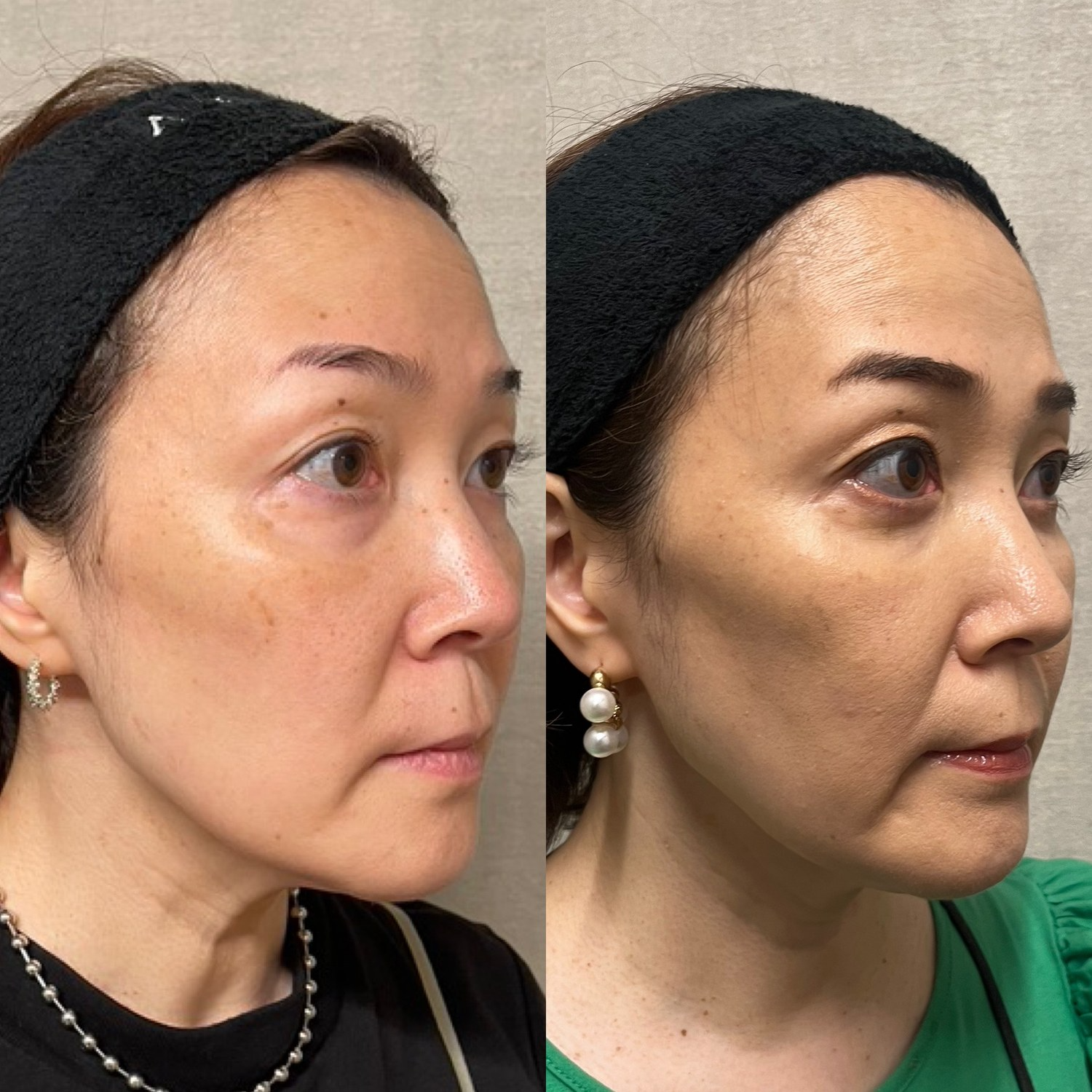 別患者様の斜め。術前と術後1ヶ月
