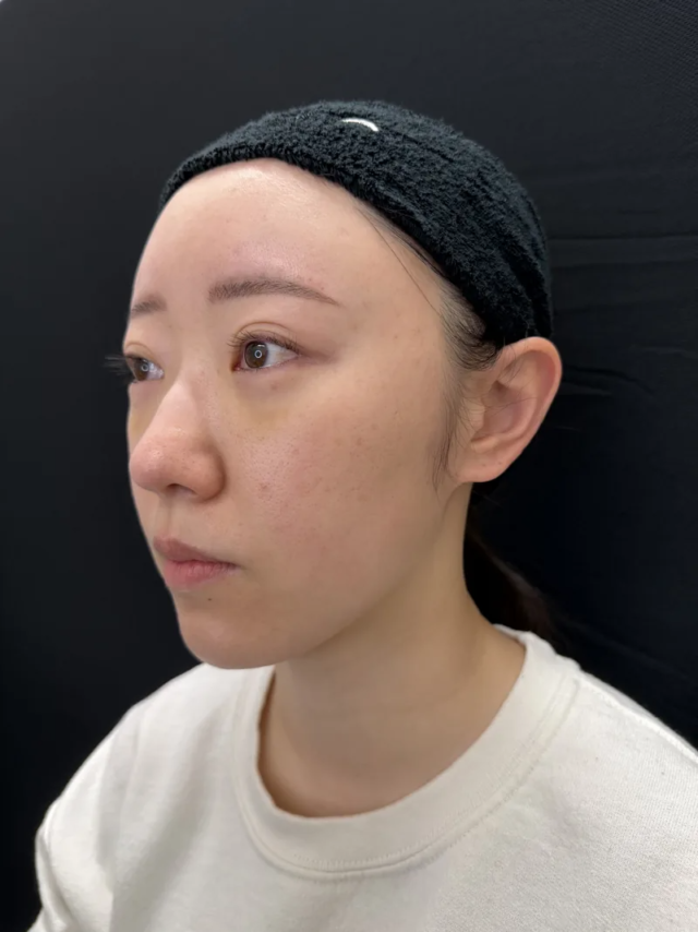 大阪 20代女性 4Dクマ取り®術 術後3日 斜め