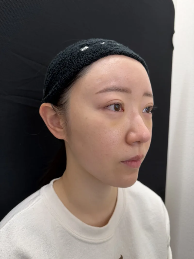 大阪 20代女性 4Dクマ取り®術 術後3日 反対側斜め