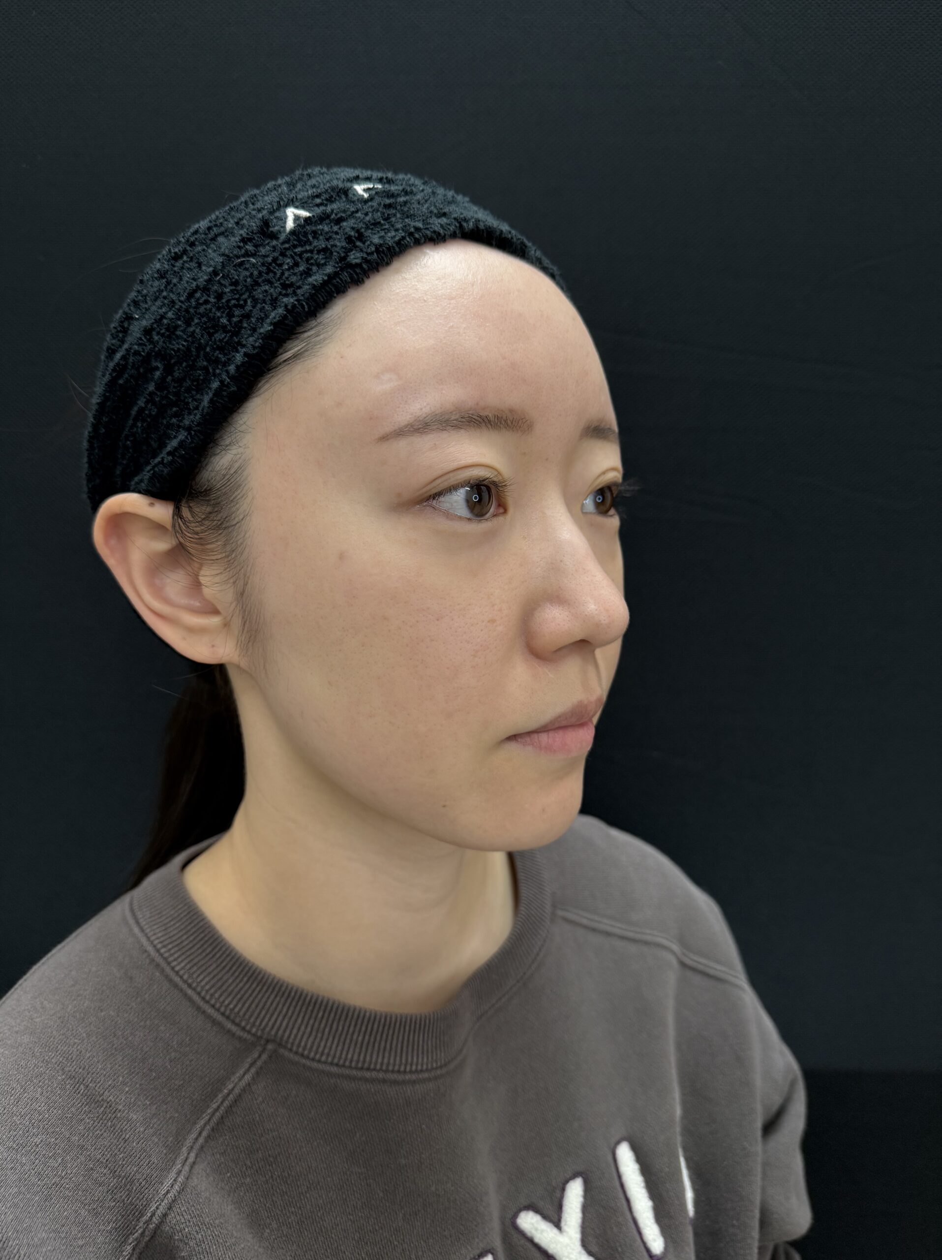 大阪 20代女性 4Dクマ取り®術 術前 斜め