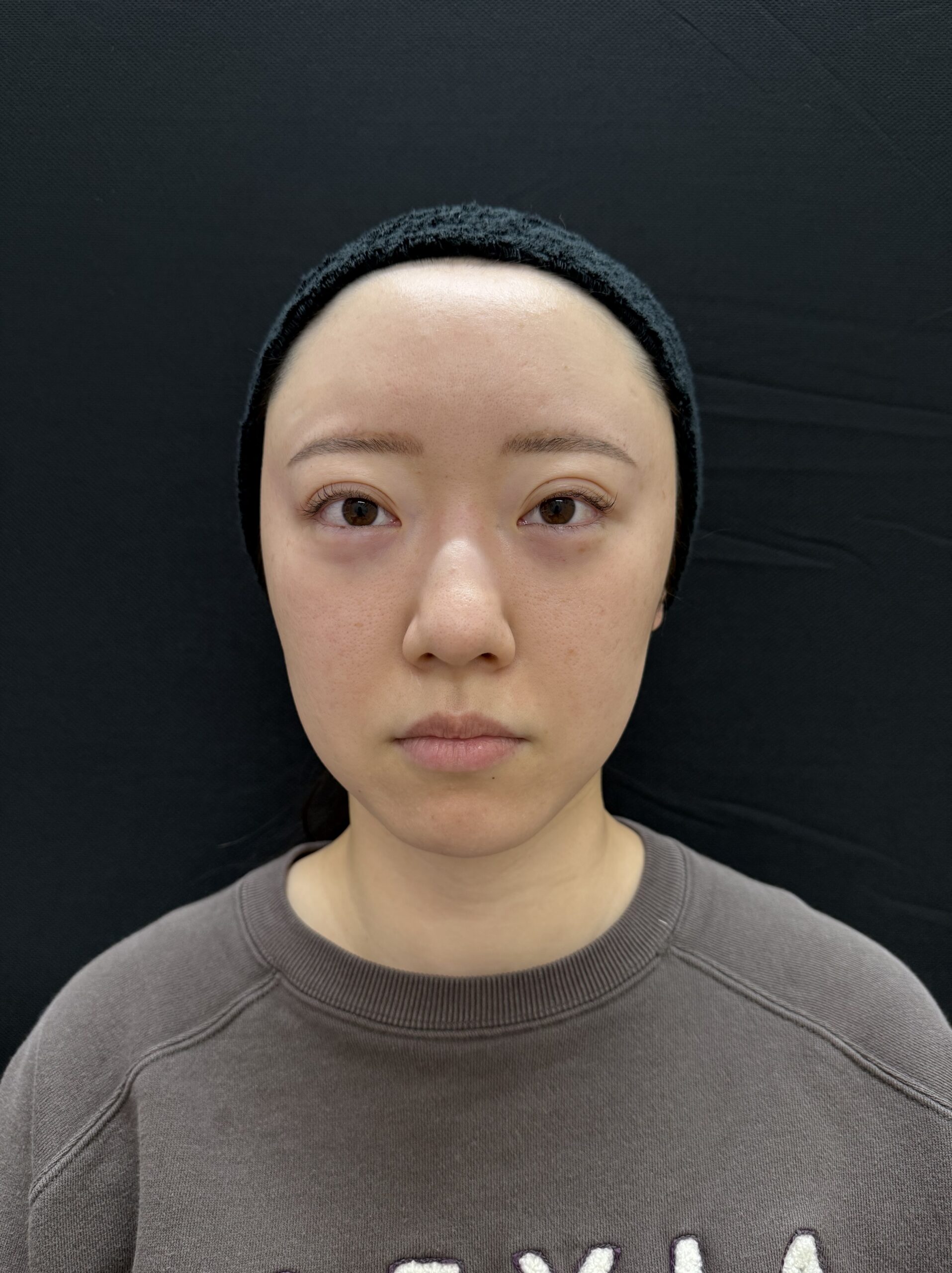 大阪 20代女性 4Dクマ取り®術 術直後 正面