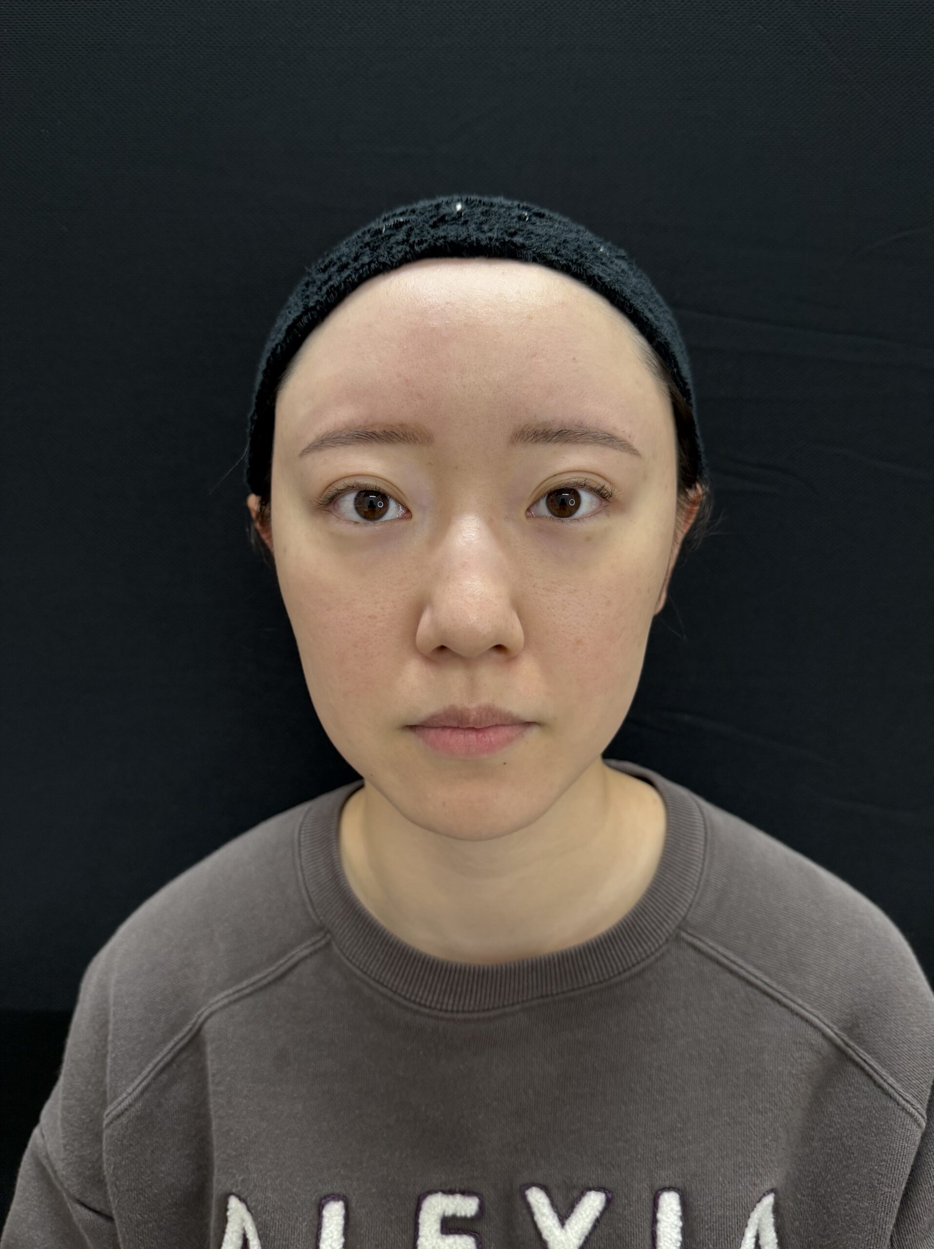 大阪 20代女性 4Dクマ取り®術 術前 正面
