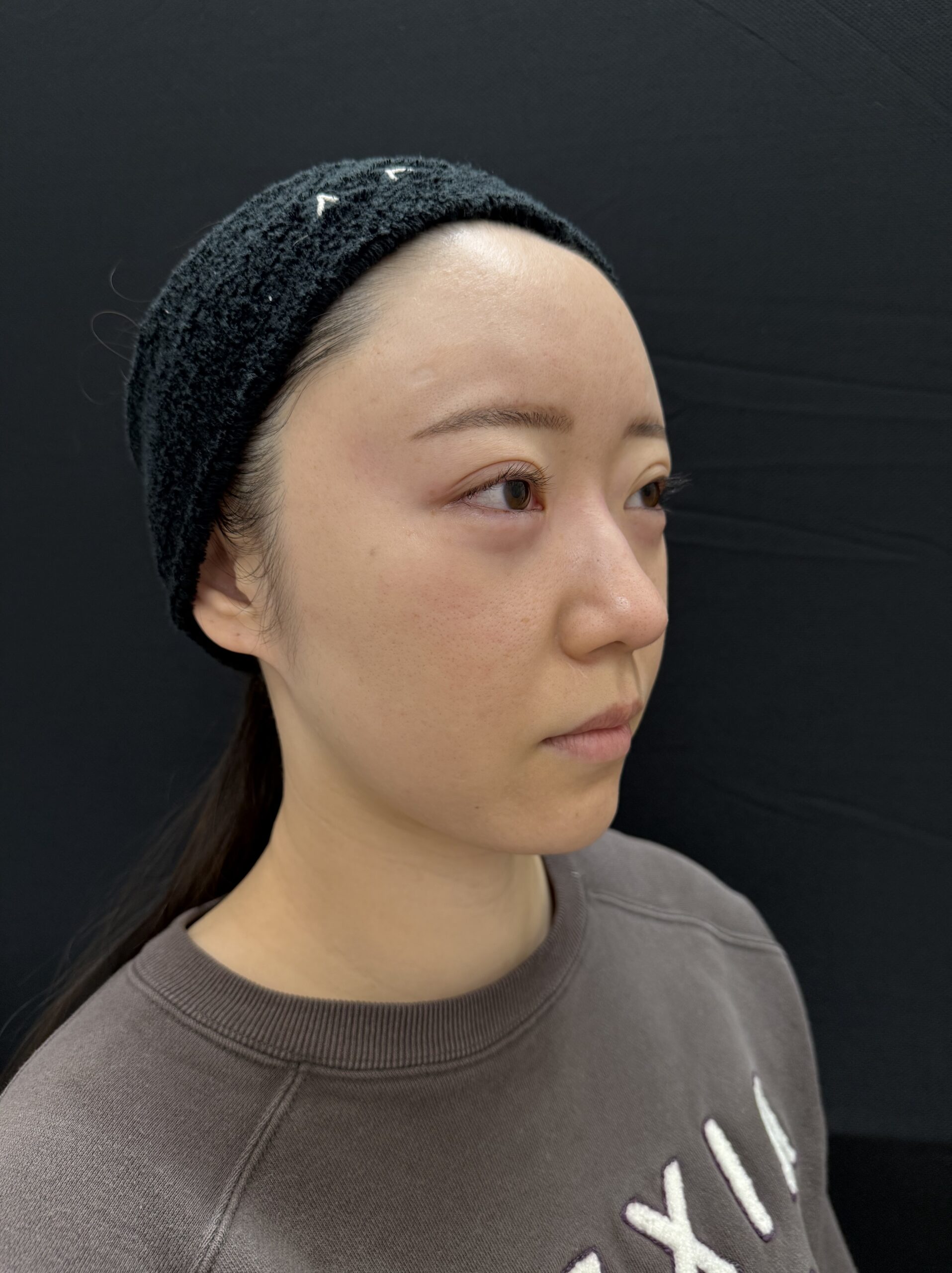 大阪 20代女性 4Dクマ取り®術 術直後 反対側斜め