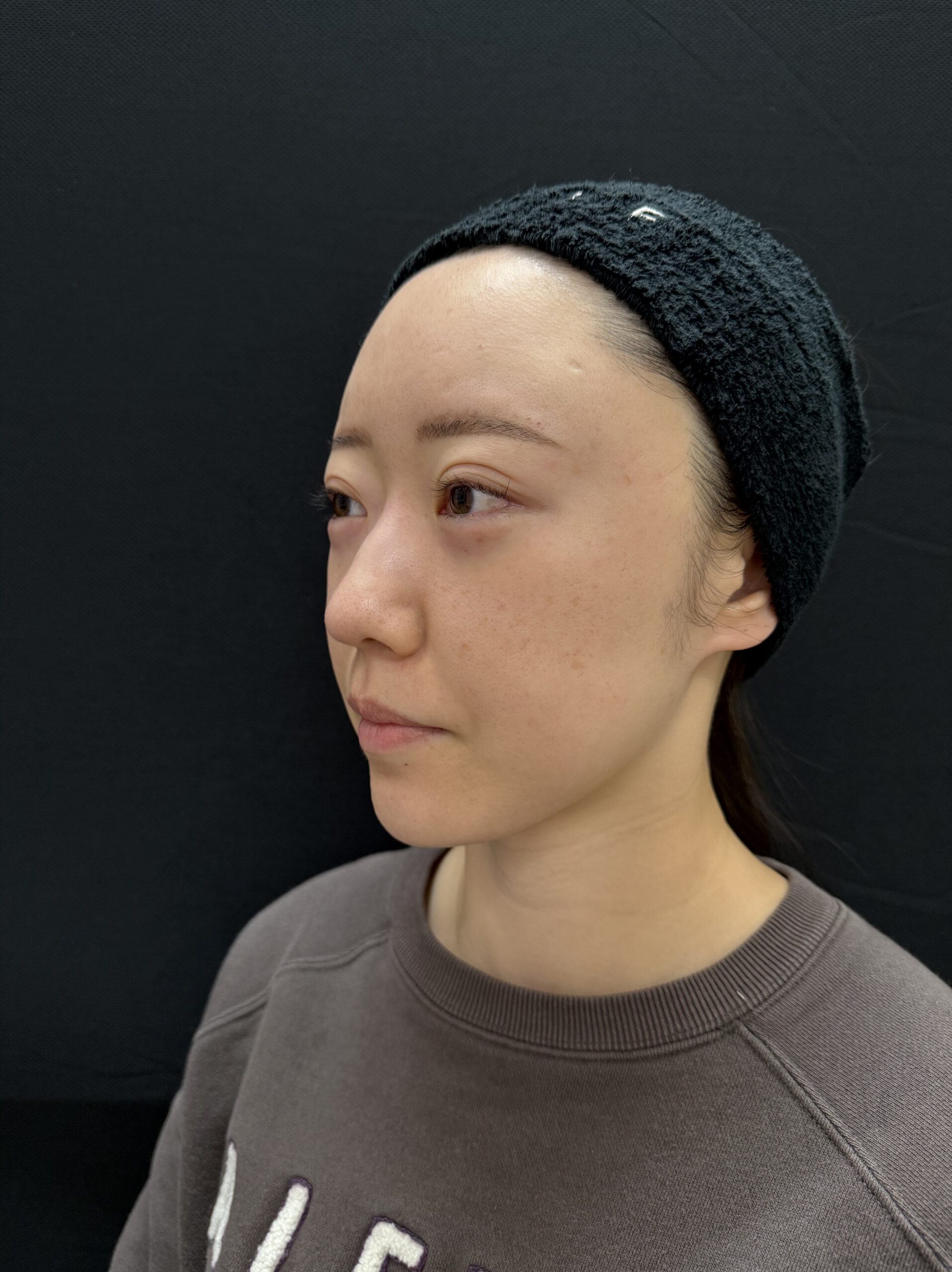 大阪 20代女性 4Dクマ取り®術 術直後 斜め