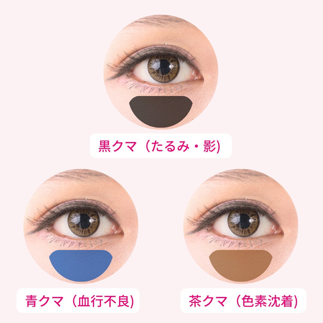 黒クマ・青クマ・茶クマの原因