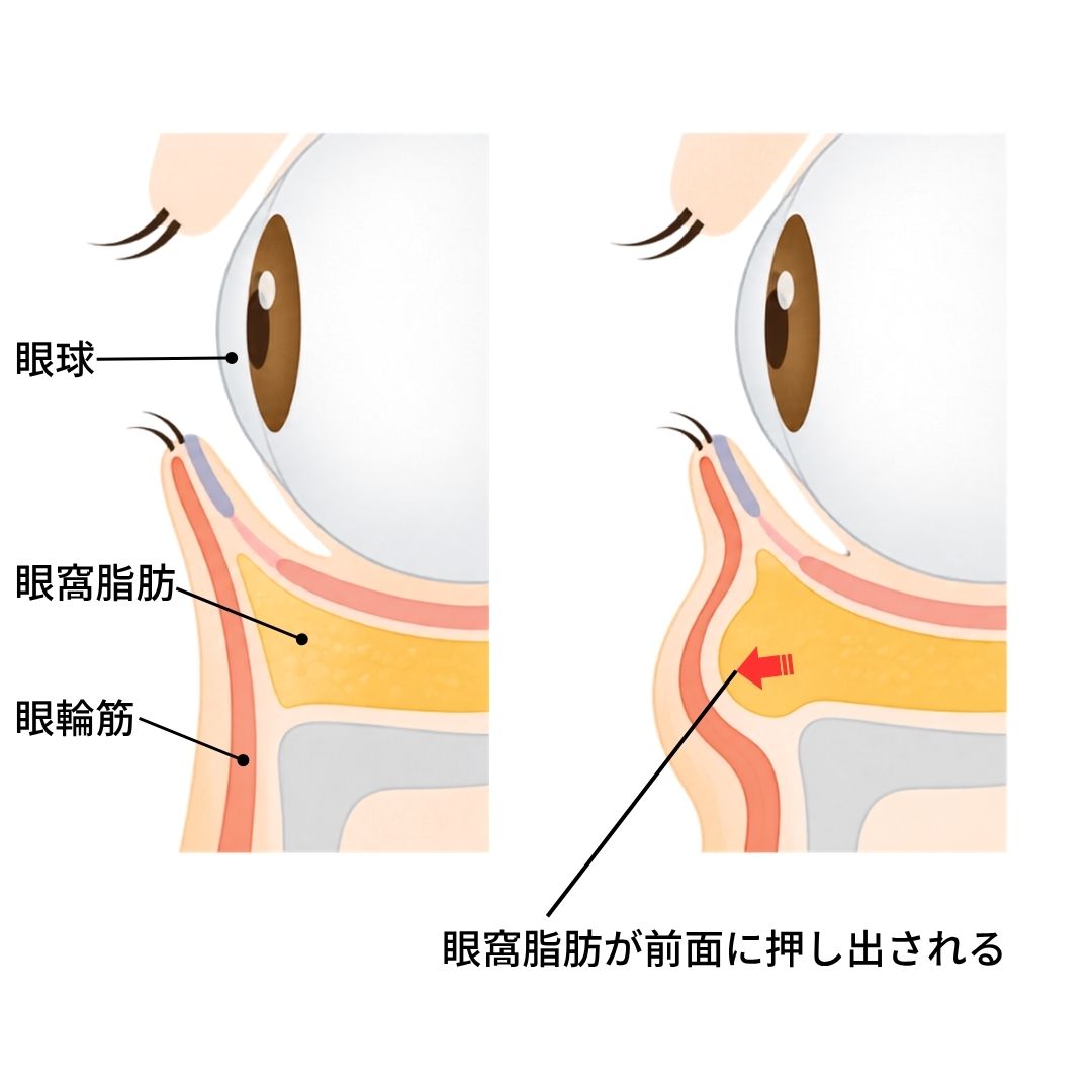 目の下がふくらむメカニズムを示した図解