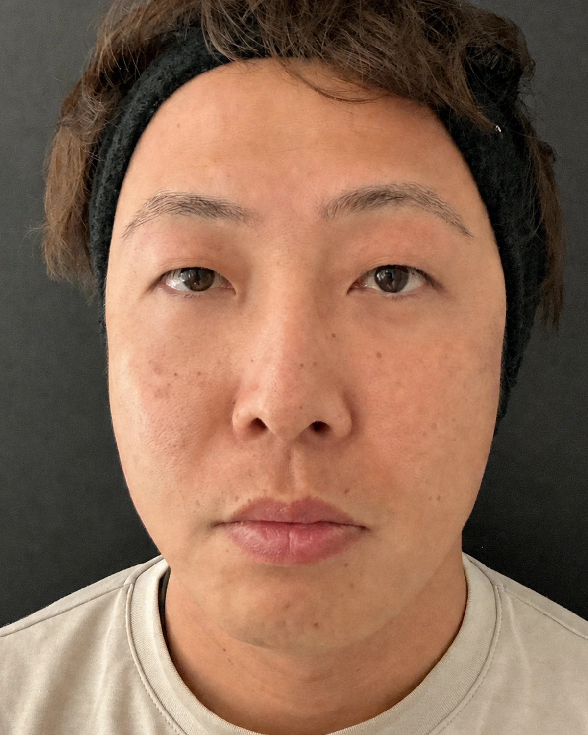 新宿の41歳男性における4Dクマ取り®術の術後1か月・正面写真