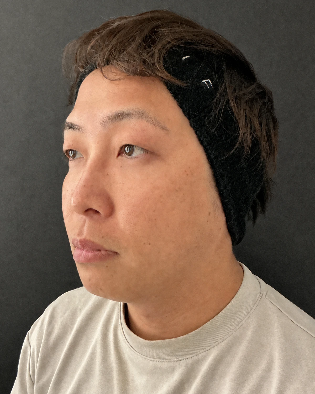 新宿の41歳男性における4Dクマ取り®術の術後1か月・斜め写真