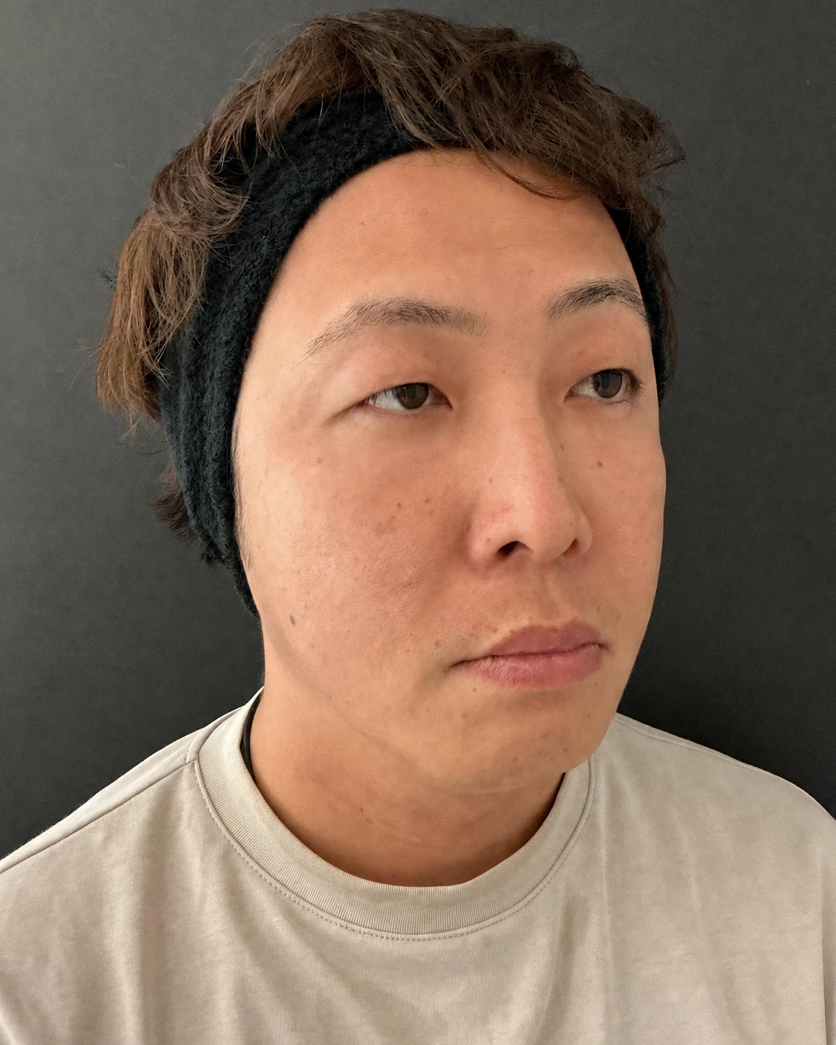 新宿の41歳男性における4Dクマ取り®術の術後1か月・反対側斜め写真