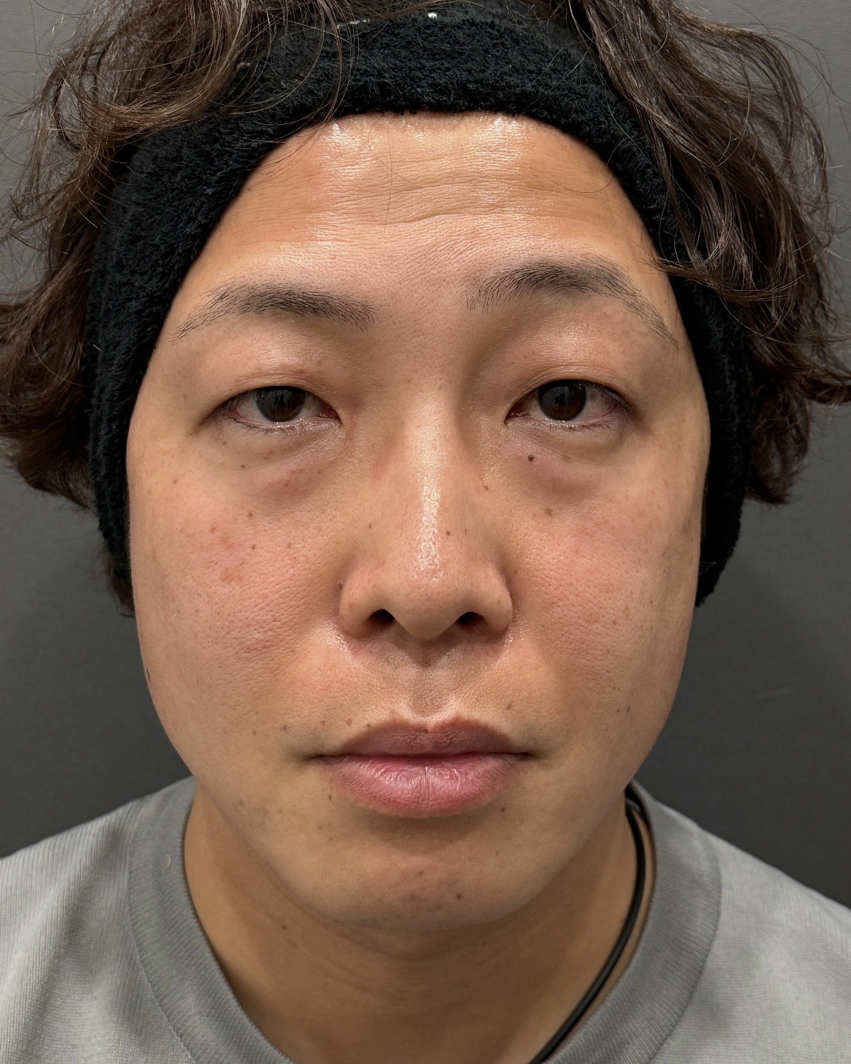 新宿の41歳男性における4Dクマ取り®術の術前・正面写真