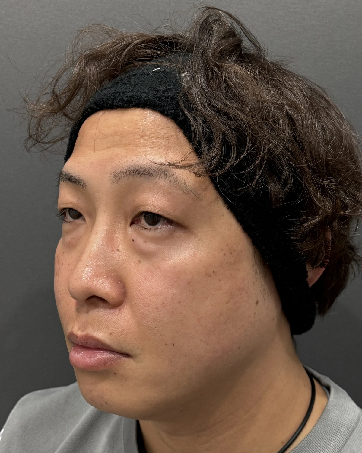 新宿の41歳男性における4Dクマ取り®術の術前・斜め写真