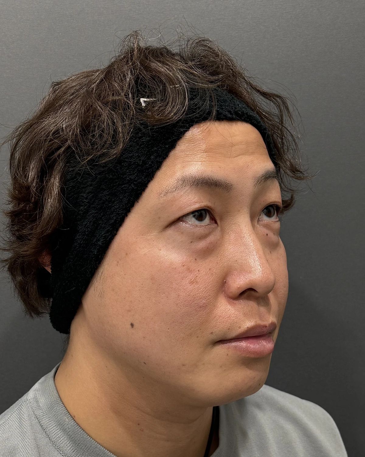 新宿の41歳男性における4Dクマ取り®術の術前・反対側斜め写真