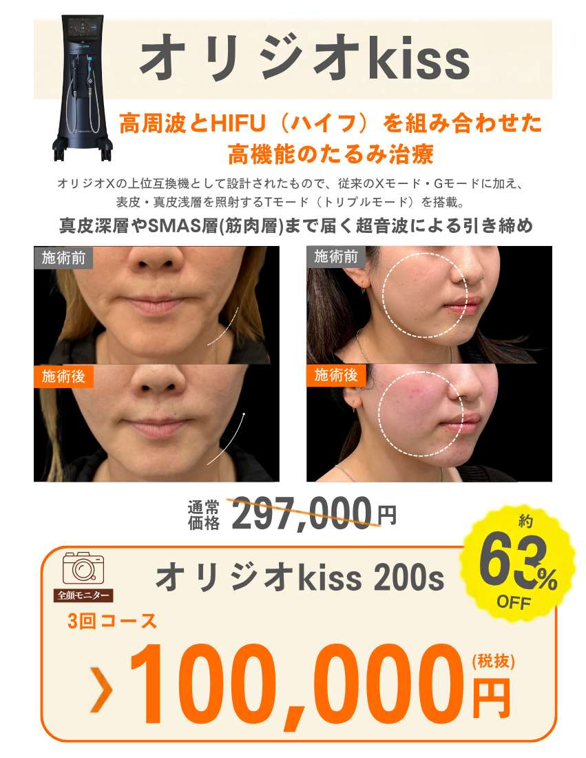 オリジオkiss 3回コース 税抜100,000円。全顔モニター・施術前後の症例写真。