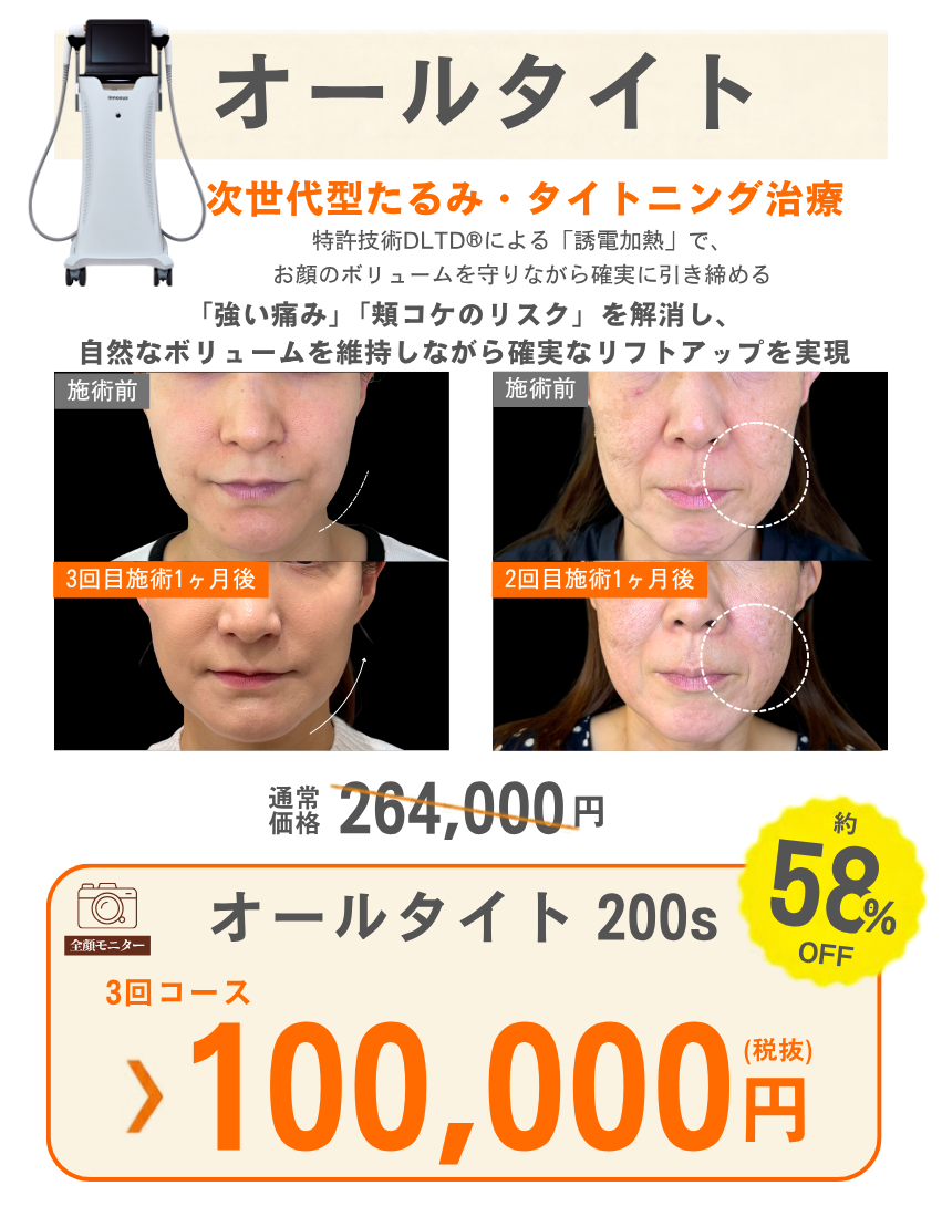 オールタイト 3回コース 税抜100,000円。全顔モニター・施術前後の症例写真。
