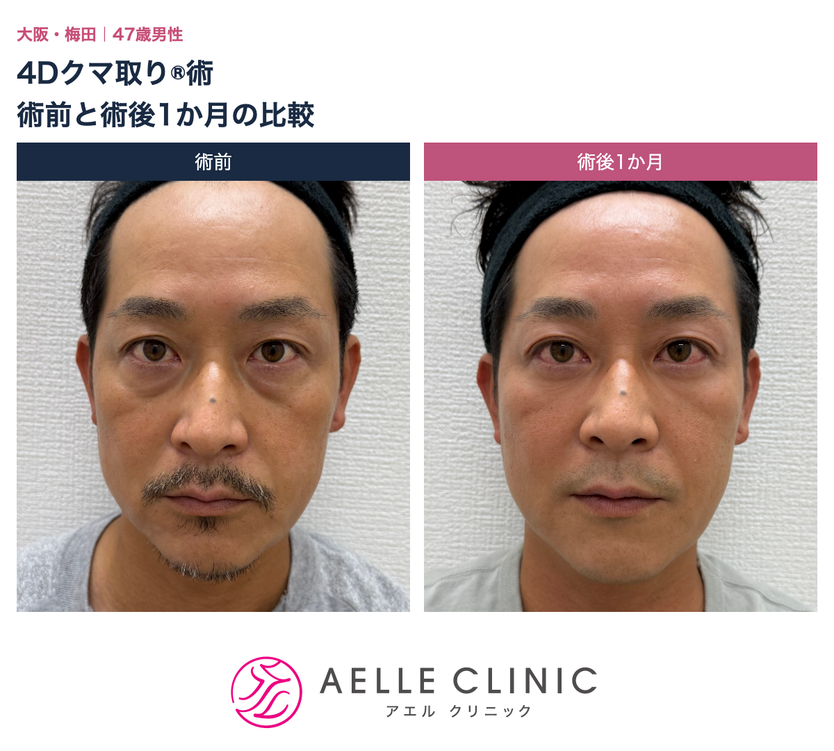 大阪院47歳男性の4Dクマ取り®︎術の術前と術後1か月