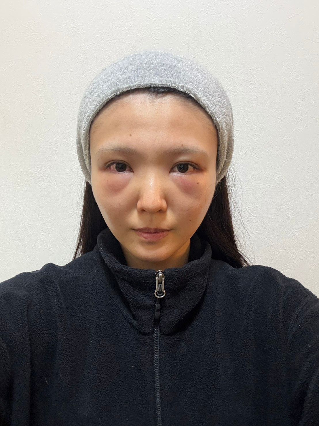 20代4Dクマ取り術の翌日の腫れ