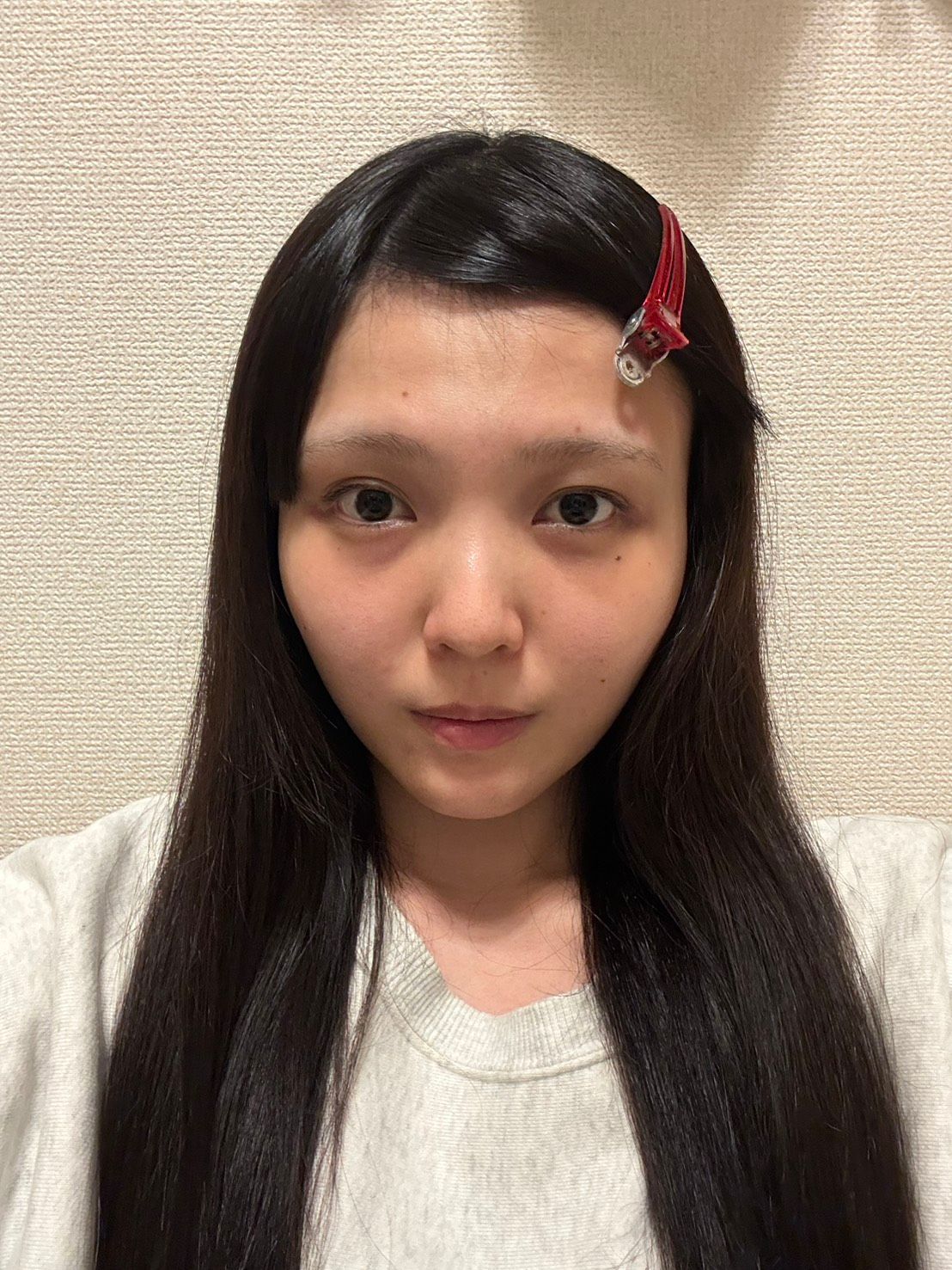 20代4Dクマ取り術の1週間後
