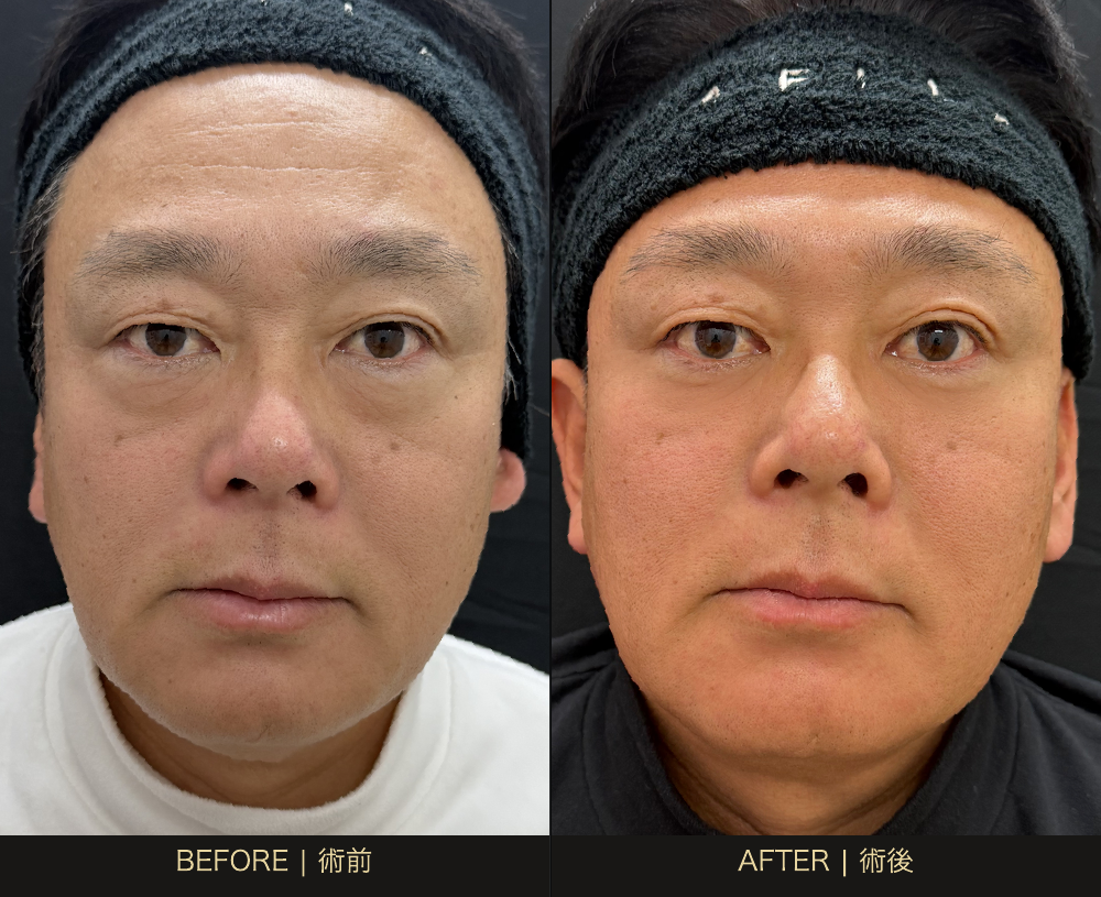 51歳男性、4Dクマ取り術の術前と術後